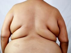 Prostorově výrazný paradox smrti: Pacienti s nižším BMI umírají častěji