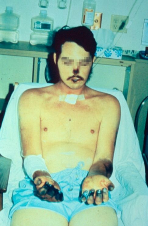 640px acral necrosis due to bubonic plague